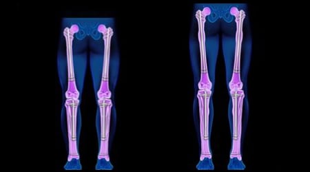 COMBINED TIBIA & FEMUR